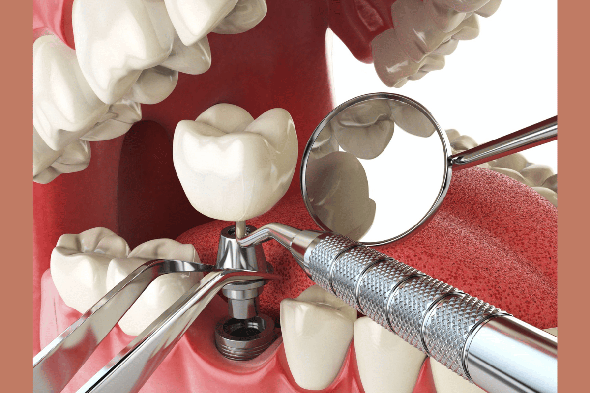 Dental Implants